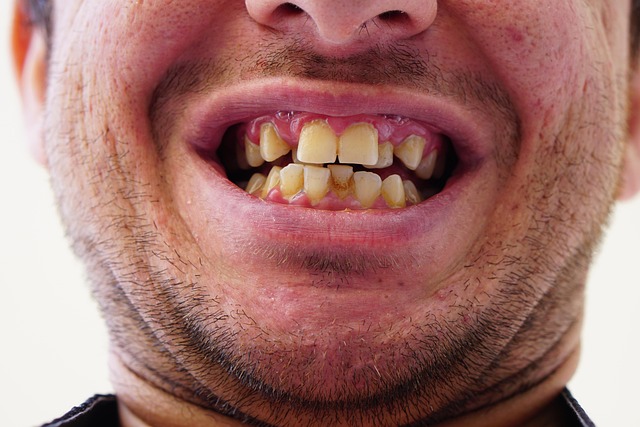 Detaljer om invisalign-behandling i København